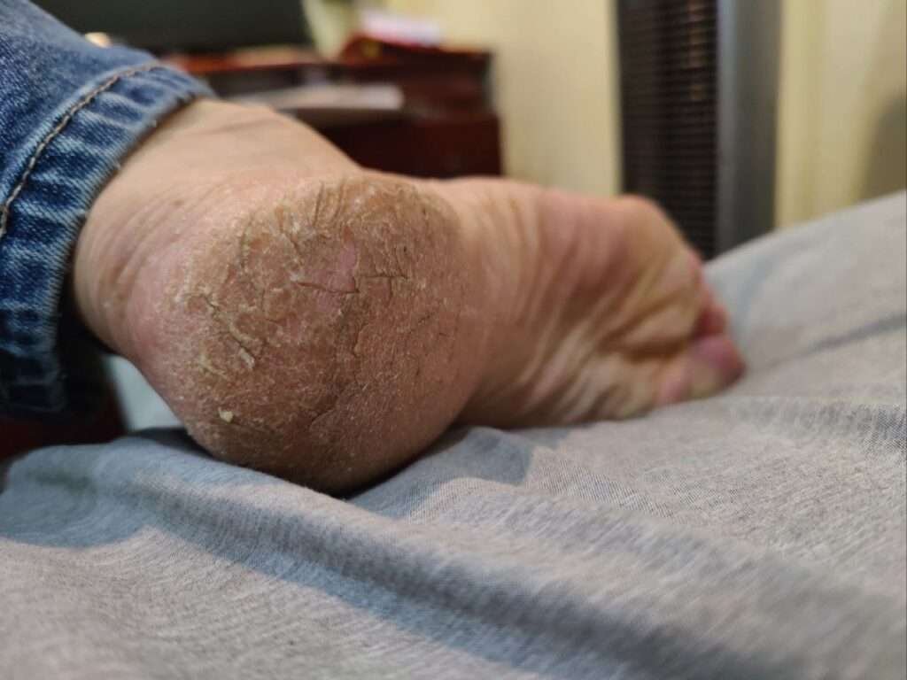 cracked heels