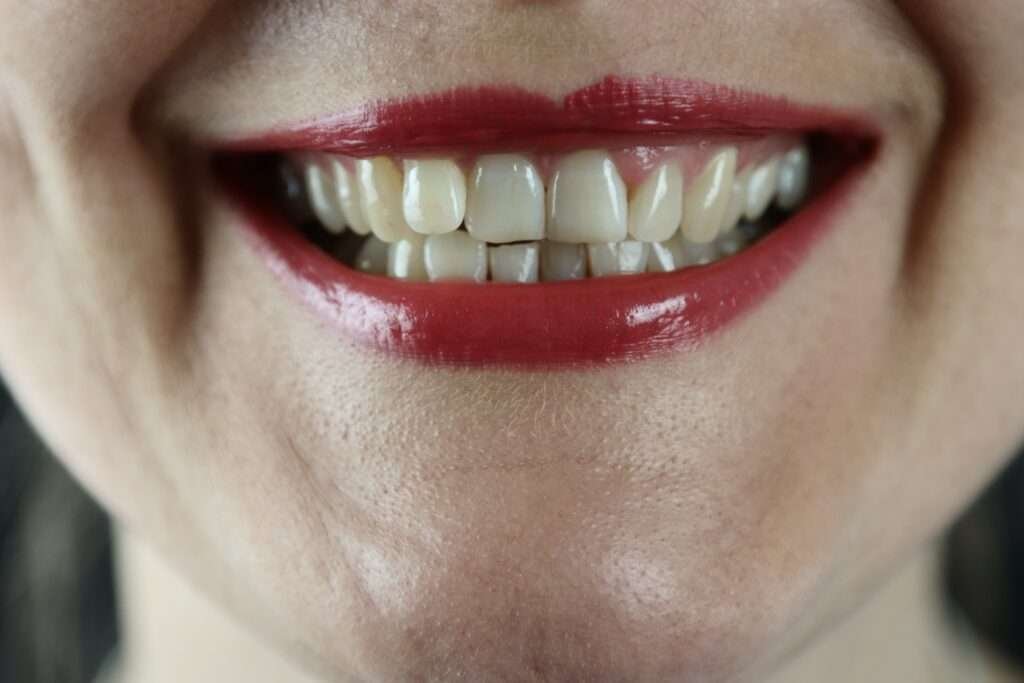 Staines on teeth