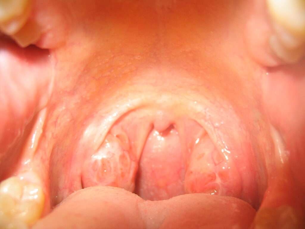 Tonsil Stones Smell