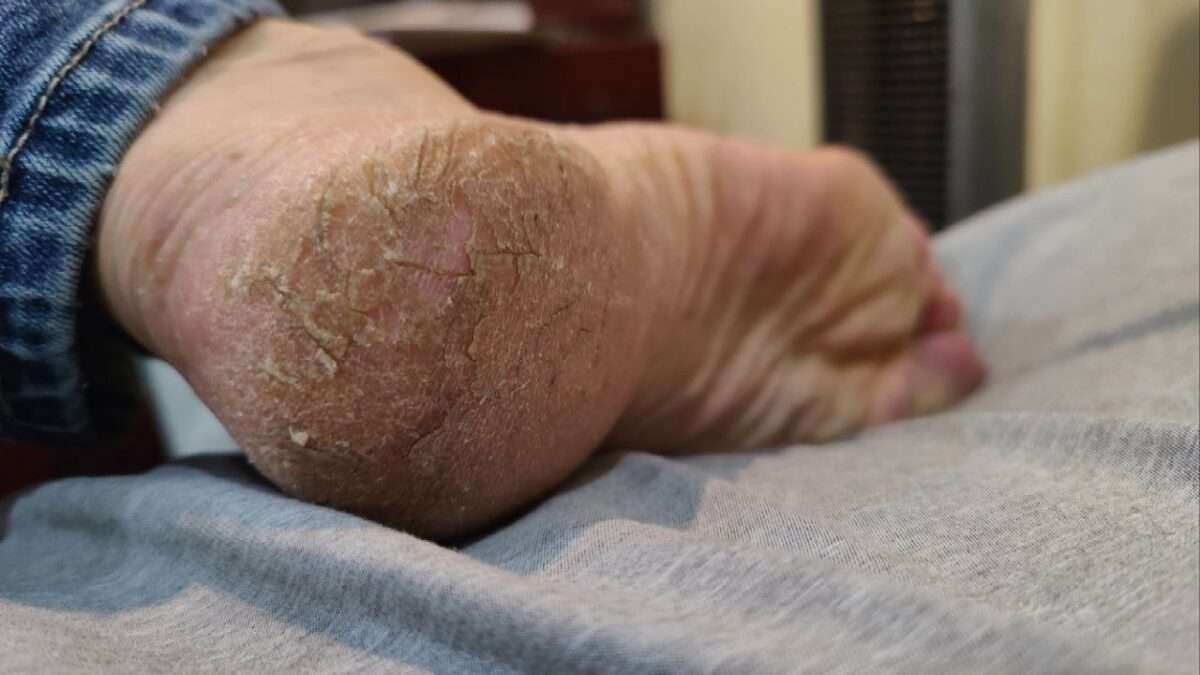 Quick Relief: Remedies for Painful Cracked Heels