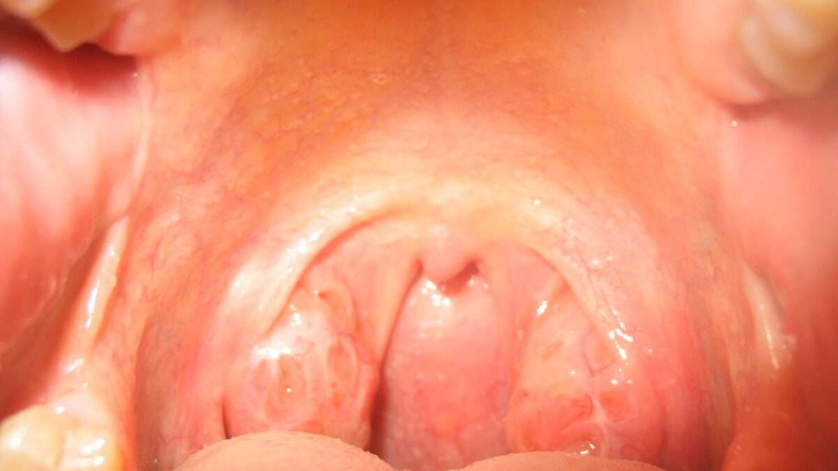Tonsil Stones Smell